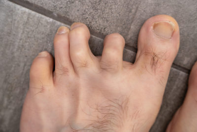 What is a Hammer Toe?, What is the Main Cause of Hammer Toes?