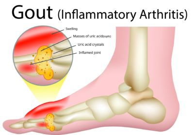 Gout Doctors Near Me