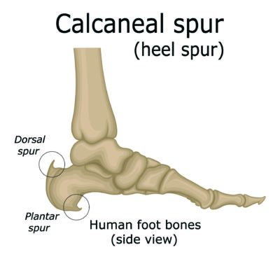 Painful prominences of the heel. | Semantic Scholar