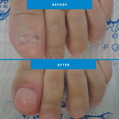 Nail Restoration - Family Foot and Ankle Care of Greenville